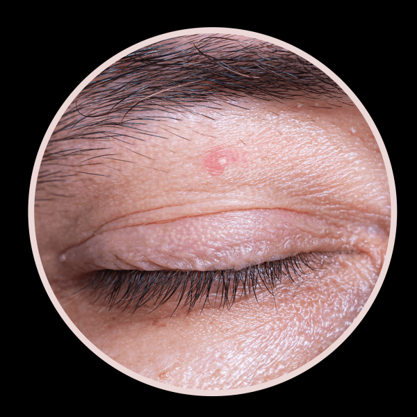 6 Types of Eyelid Bumps and How to Treat Them According to Dermatologists